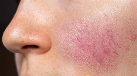 Rosacea Causes Symptoms And Treatments Myskyn Clinic