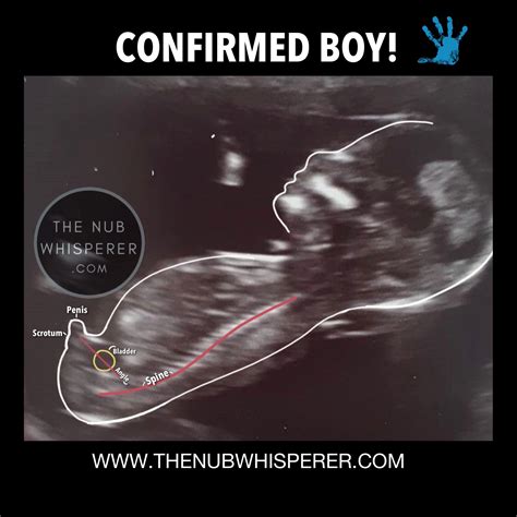 Nub Theory Gender Prediction Gender Prediction Nub Theory Baby Scan