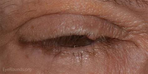 Epidermal Inclusion Cyst Eyelid