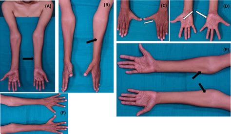 (A-F). Wasting of bilateral medial forearm (left > right) with relative ...