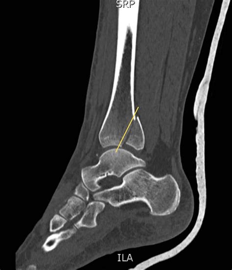 Displaced Trimalleolar Ankle Fracture