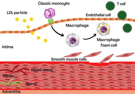 血管炎症和心血管疾病回顾 PET 成像的作用 The International Journal of Cardiovascular