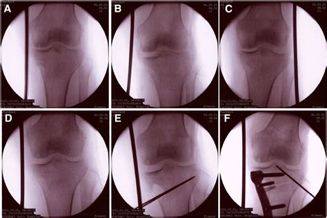 Superficial Medial Collateral Ligament Transection Sufficiently