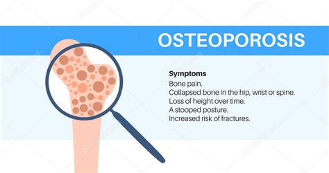 Enfermedad De Osteoporosis Trastorno Esquel Tico Sist Mico P Rdida De