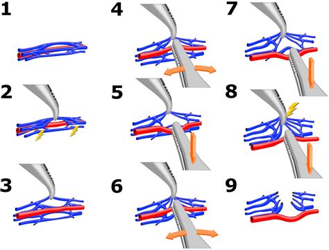 Laparoscopic Lymphatic And Artery Sparing Microsurgical Varicocelectomy