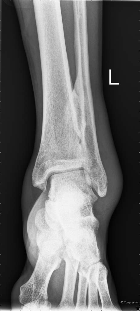 Distal Tibiofibular Joint