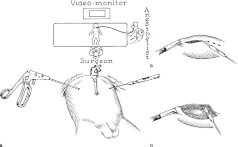 Congenital Pyloric Stenosis And Duodenal Obstruction Basicmedical Key