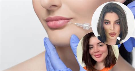 Remoção De Preenchimento Labial Entenda Procedimento Feito Por Gkay