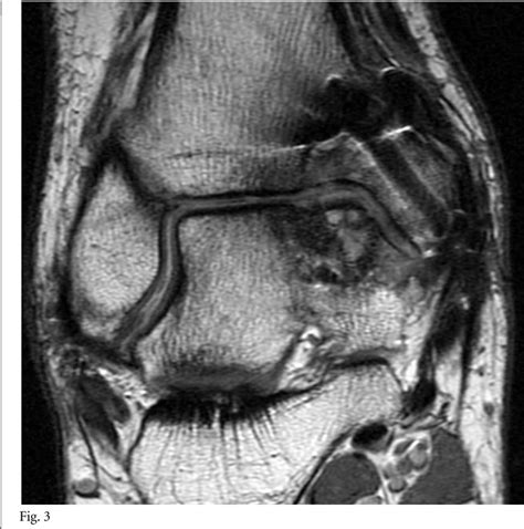 Figure From Allograft Compared With Autograft In Osteochondral