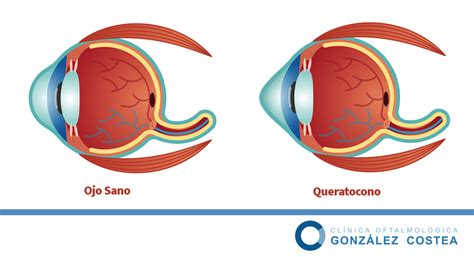 Qué es el queratocono Causas y Tratamiento