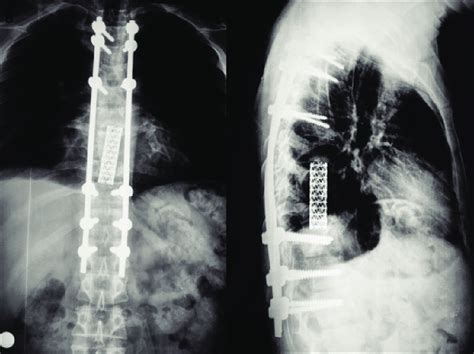 Postoperative Anteroposterior Left And Lateral Right Radiographs Download Scientific