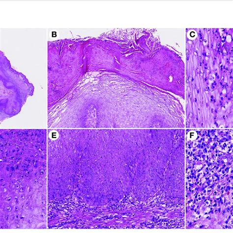 Histopathological Changes In CVC A Low Magnification Showed An