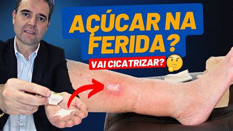 Açúcar na ferida técnica milagrosa ou apenas mais um mito Dr Alex