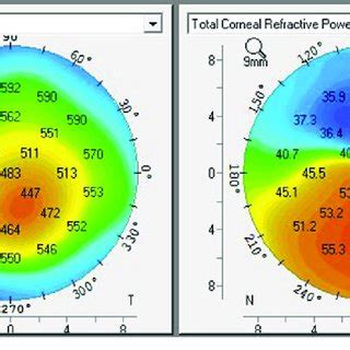 Pdf Corneal Thickness And Volume In Subclinical And Clinical Keratoconus