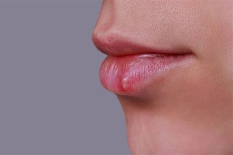 Natürliche Hausmittel gegen Herpes schonheitstipps