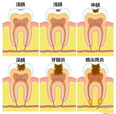 蛀牙怎么办（蛀牙治疗方法介绍） 说明书网