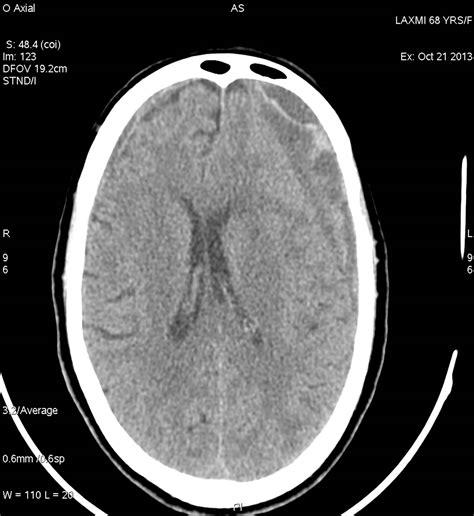 Chronic Sub Dural Haematoma