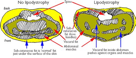 Fat accumulation | Guides | HIV i-Base