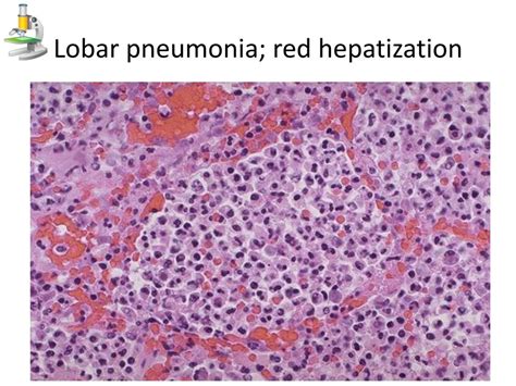 Ppt Pneumonia By Dr Abdelaty Shawky Assistant Professor Of Pathology Powerpoint Presentation