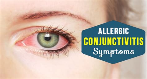 Allergic Conjunctivitis Symptoms - Allergy-symptoms.org