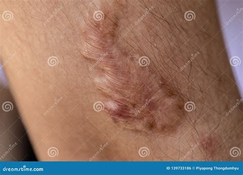 A Scar Is An Area Of Fibrous Tissue That Replaces Normal Skin Royalty
