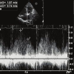 Transthoracic Echocardiographic Pulmonary Venous Flow In A Patient With