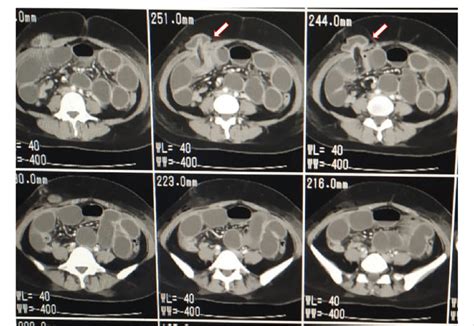 Contrast Enhanced Computed Tomography Cect Scan Shows The Dilated