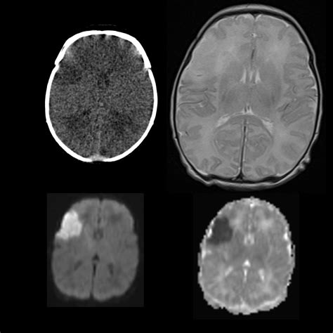 Pediatric Acute Ischemic Stroke Pediatric Radiology Reference Article