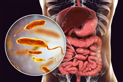 Kolera Gejala Penyebab Diagnosis Dan Pengobatan Doktersehat