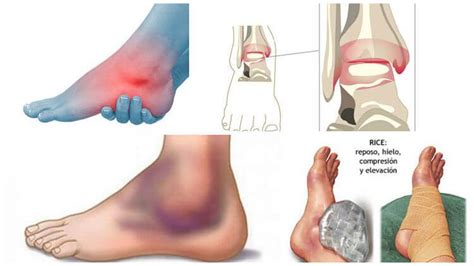 Pin En Tratamiento Tobillos Hinchados