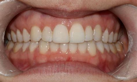 Straight Smile With Invisalign Before And After Photos Mona Vale Nsw