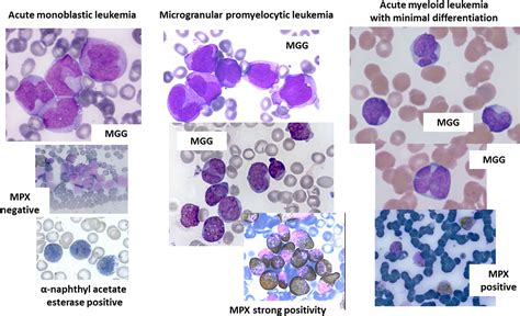 Promyelocyte Lineage