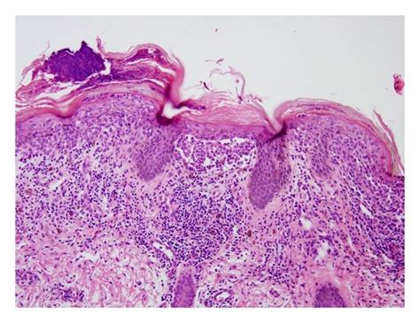 Skin Biopsy Hande Stain ×200 Dense Deposit Of Langerhans Cells With