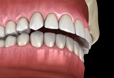 Overbite Dental Occlusion Malocclusion Of Teeth Medically Accurate