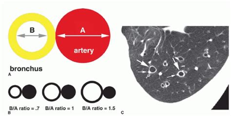 Airway Disease Bronchiectasis Chronic Bronchitis And Bronchiolitis