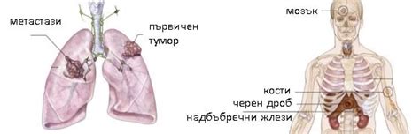 Рак на белия дроб: симптоми по стадии. Какво да правя? Всички ...