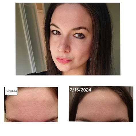 Does tret work? 5 year update. : r/tretinoin