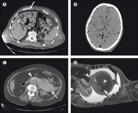 Post Mortem Imaging As An Alternative To Autopsy In The Diagnosis Of