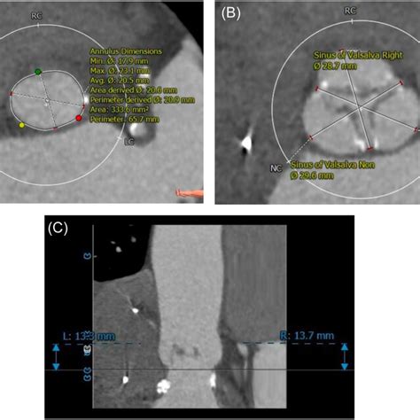 Tavr Ct Sizing In The Small Aortic Annulus 62‐year‐old Female Patient