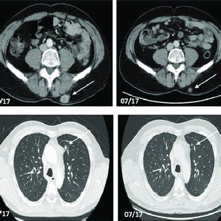 Axial Contrast Enhanced Ct Scans Of A Year Old Male Patient