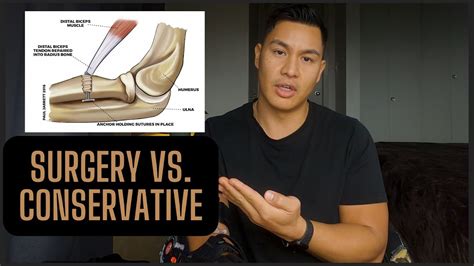 Why I Chose Surgery Over Non Surgery 2023 Distal Bicep Tendon Rupture Youtube