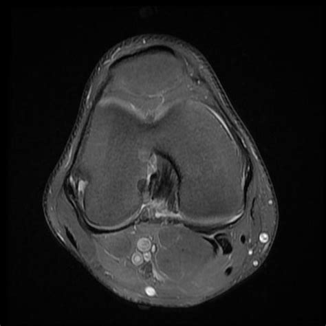 Osteochondritis Dissecans Image