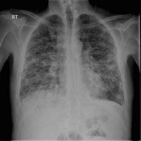 Lymphangiosis Carcinomatosa Pacs