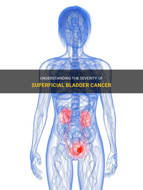 Understanding The Severity Of Superficial Bladder Cancer Medshun