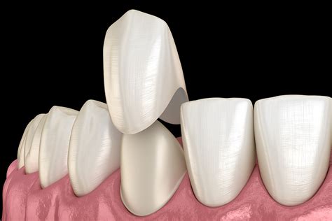 The Pros And Cons Of Dental Crowns Commercial Road Dental