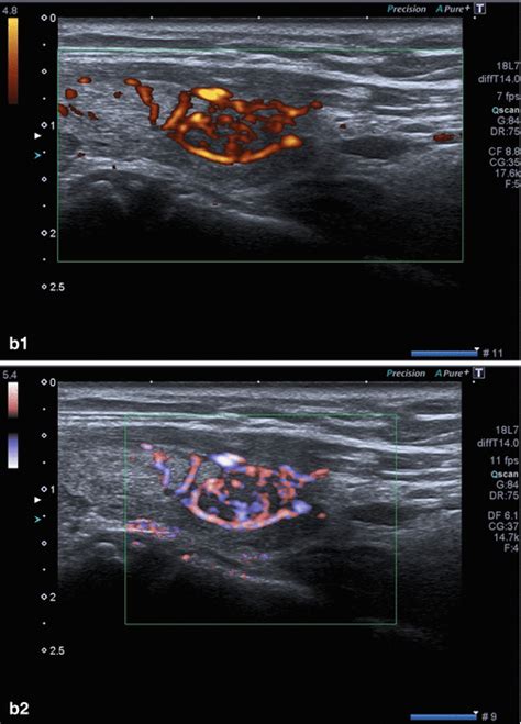 Thyroid Gland | Radiology Key