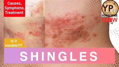 Shingles What You Should Know About It Causes Symptoms And Treatment Is Shingles Contagious