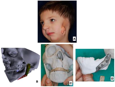 Use Of A Fibula Free Flap For Mandibular Reconstruction In Severe