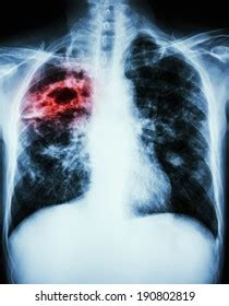 Lobar Pneumonia Film Chest Xray Show Stock Photo 496592959 Shutterstock