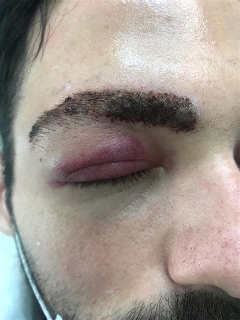 Implante De Cejas En Valencia Unidad Capilar Corporal Core